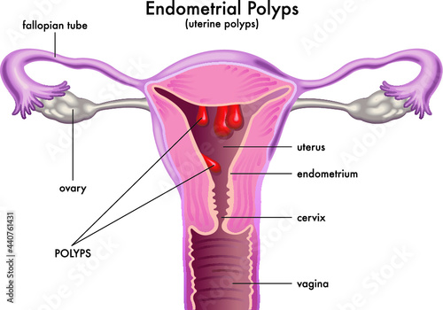 Medical illustration shows a female reproductive system with endometrial polyps, with annotations.