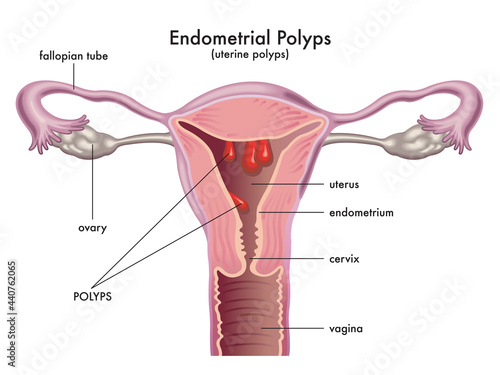 Medical illustration shows a female reproductive system with endometrial polyps, with annotations. photo