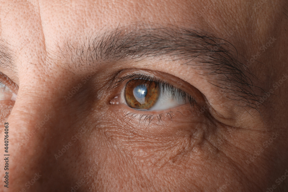 Closeup view of mature man suffering from cataract Closeup view of mature man suffering from cataract