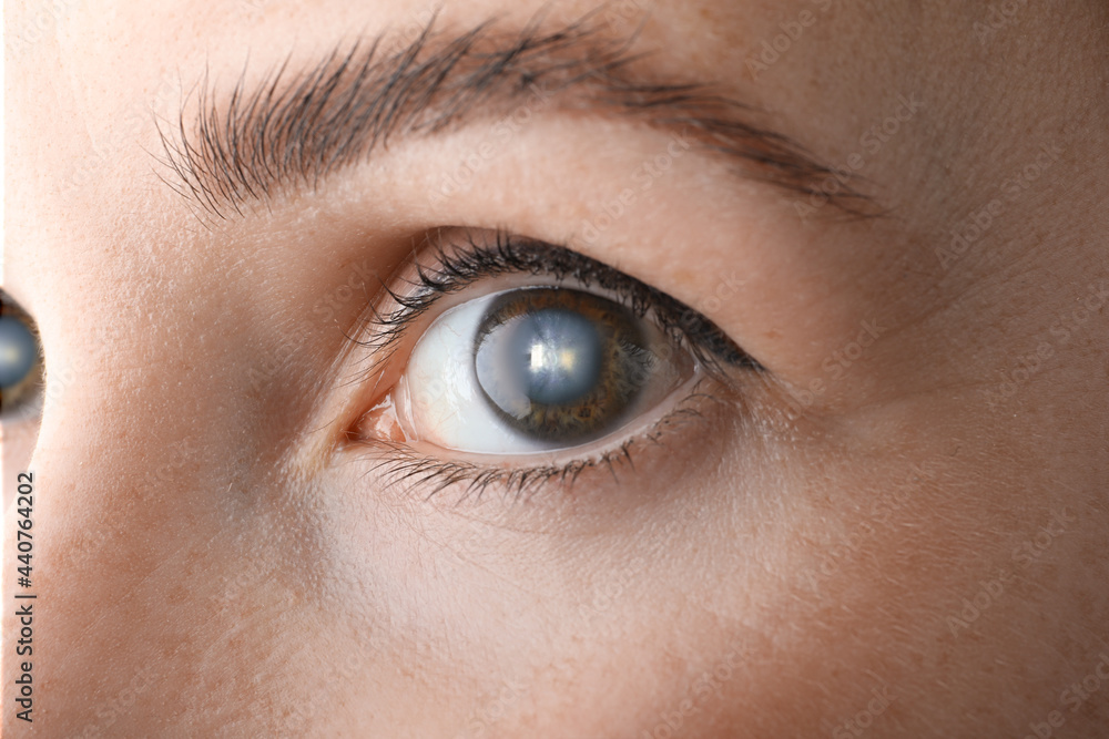 Closeup view of woman suffering from cataract Closeup view of woman suffering from cataract