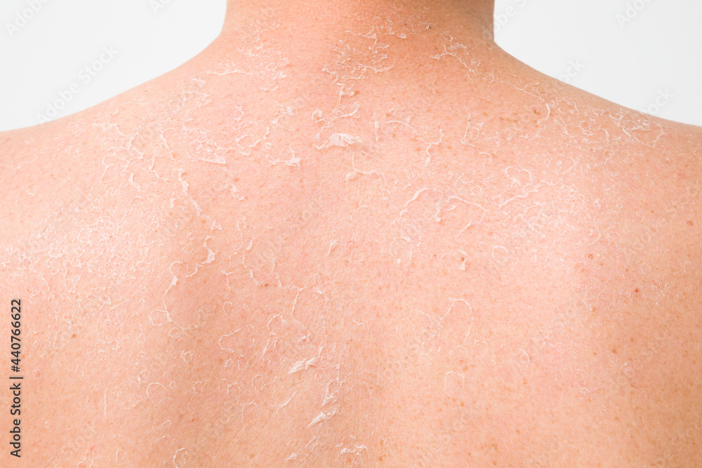 Young adult man back after sun burn damage. Peeled dry skin. Closeup. Rear view. Young adult man back after sun burn damage. Peeled dry skin. Closeup. Rear view.
