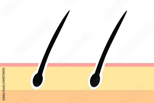 毛根のイラスト