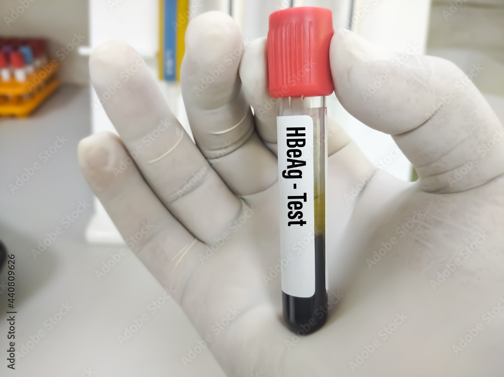 Blood Sample For HBeAg (Hepatitis B Virus Envelop Antigen) Quantitative ...