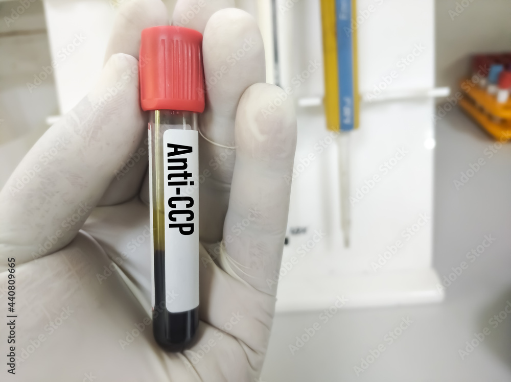 Blood sample tube for anti-CCP test, diagnosis for rheumatoid arthritis disease