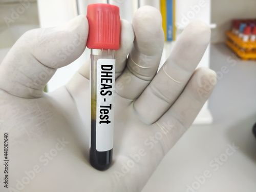 Test Tube with blood sample for DHEAS (dehydroepiandrosterone sulfate) hormone test. A medical testing concept in the blue background. photo