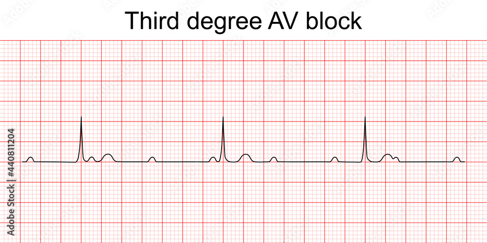 Third Degree Heart Block