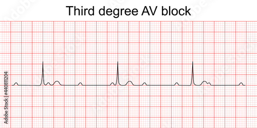 Electrocardiogram show third degree (complete) AV block pattern. ECG. EKG. Vital sign. Heart beat. Life line. Medical healthcare symbol.