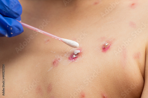 Fotografie treatment of ulcers from chickenpox, varicella with medical cream