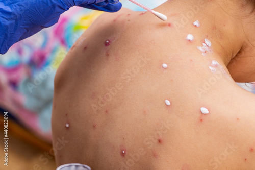 Fotografie treatment of ulcers from chickenpox, varicella with medical cream