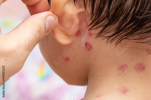 Fotografie treatment of ulcers from chickenpox, varicella with medical cream on kid head