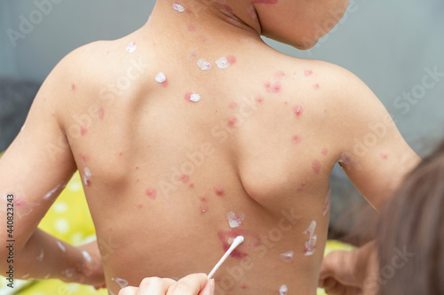 Obraz na plátně treatment of ulcers from chickenpox, varicella with medical cream on the kid ski
