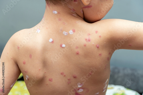 Fotografie treatment of ulcers from chickenpox, varicella with medical cream on the kid ski