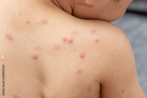Bilde på lerret treatment of ulcers from chickenpox, varicella with medical cream on the kid ski