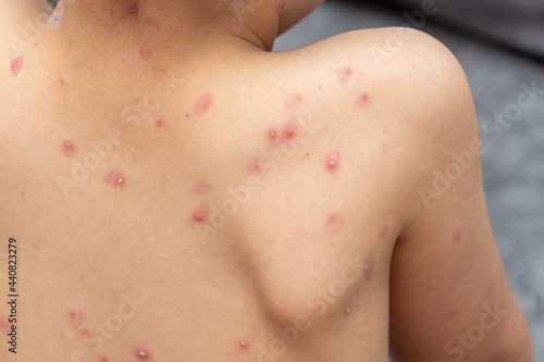 treatment of ulcers from chickenpox  varicella with medical cream on the kid skin