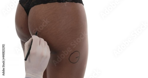 Plastic surgery doctor pointing out the problem parts of woman body. Buttock augmentation surgery. Isolated on the white background.