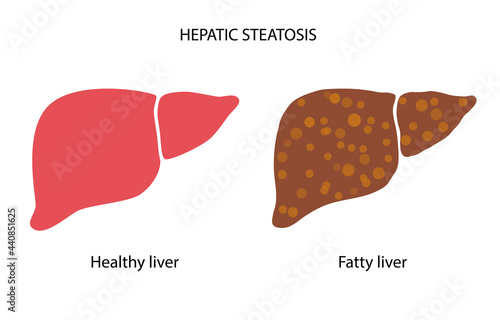 Liver disease concept