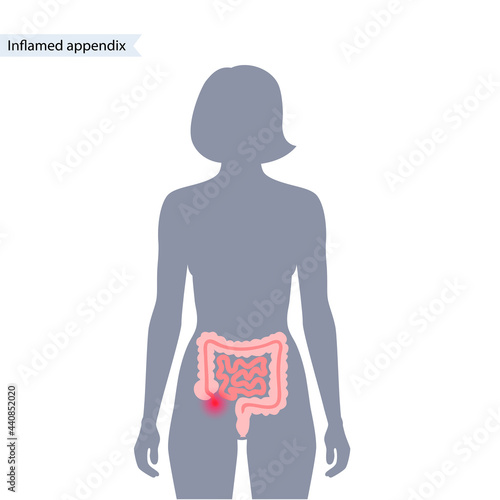 Appendix pain concept