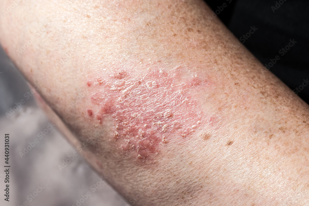 Fototapeta premium Psoriasis am Unterarm