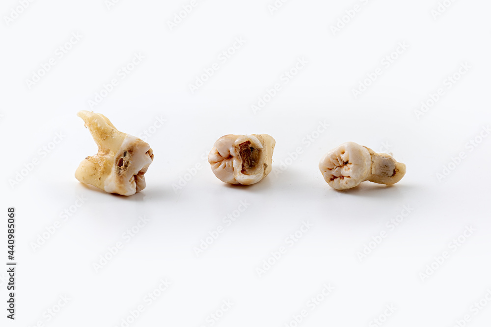 bad broken tooth adult man with severe tooth decay also known as dental caries or cavities due to bad oral hygiene, close up isolated on white background bad broken tooth adult man with severe tooth decay also known as dental caries or cavities due to bad oral hygiene, close up isolated on white background