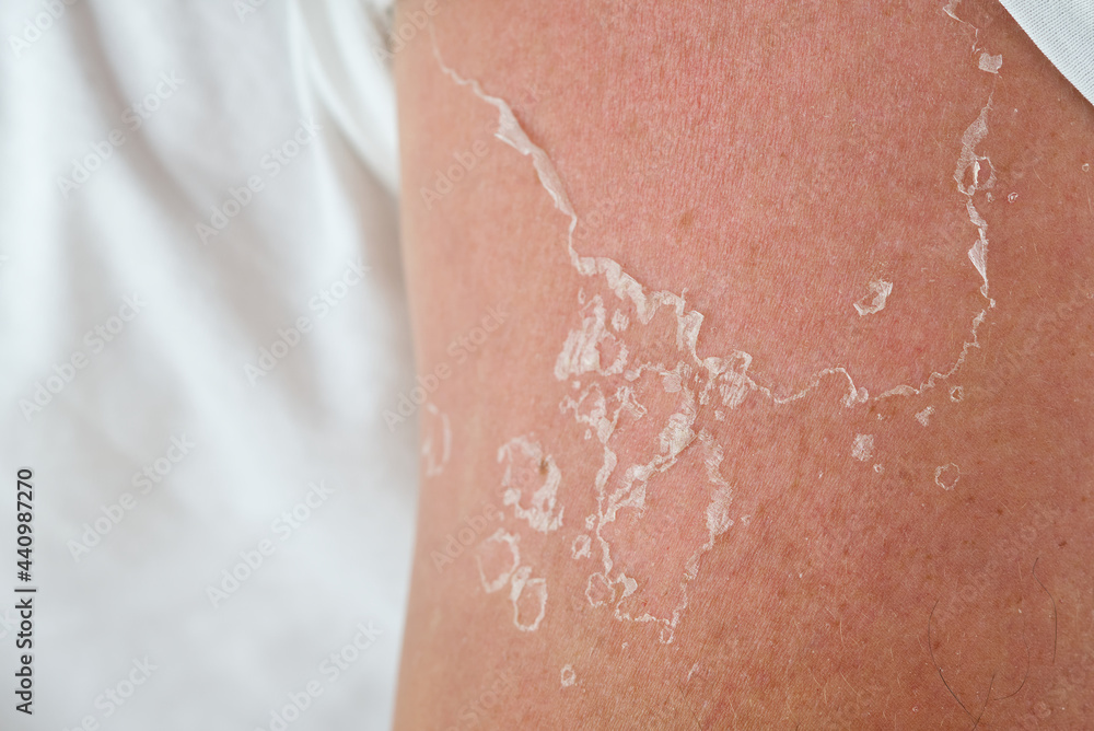 peeling of skin after burned by sunlight. not using sunscreen. sunburn of the skin peeling of skin after burned by sunlight. not using sunscreen. sunburn of the skin