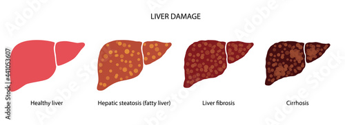 Liver disease concept