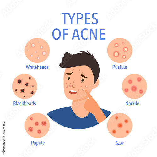 Types of acne on the skin infographic in flat design. Worry man on pimple skin problem.