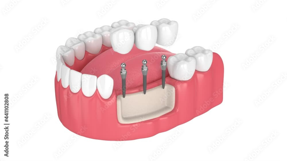 Dental bridge supported by mini dental implants over white background Dental bridge supported by mini dental implants over white background
