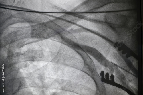 x ray image perform saphenous vein graft angiogram in patient  photo