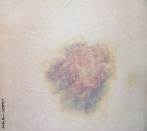 Close up of a hematoma on the leg skin.