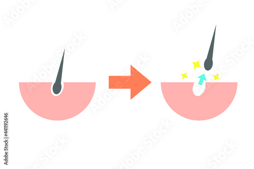 脱毛または抜け毛のイメージ　ベクターイラスト