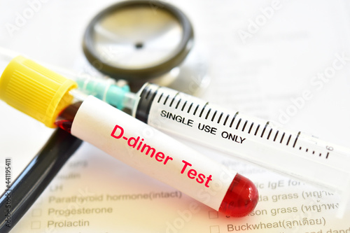 Blood sample tube for D-dimer test, diagnosis for intravascular thrombosis after COVID-19 vaccination photo