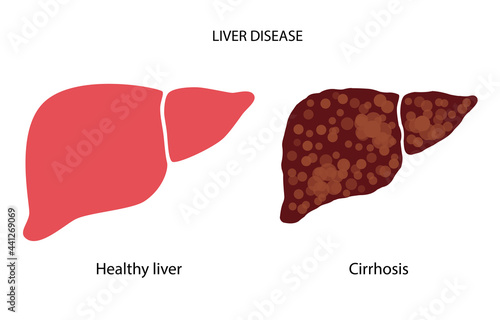 Liver disease concept