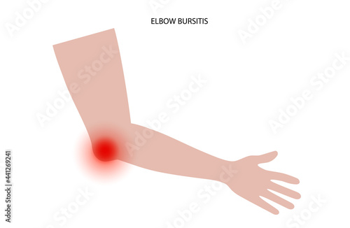 Student elbow bursitis