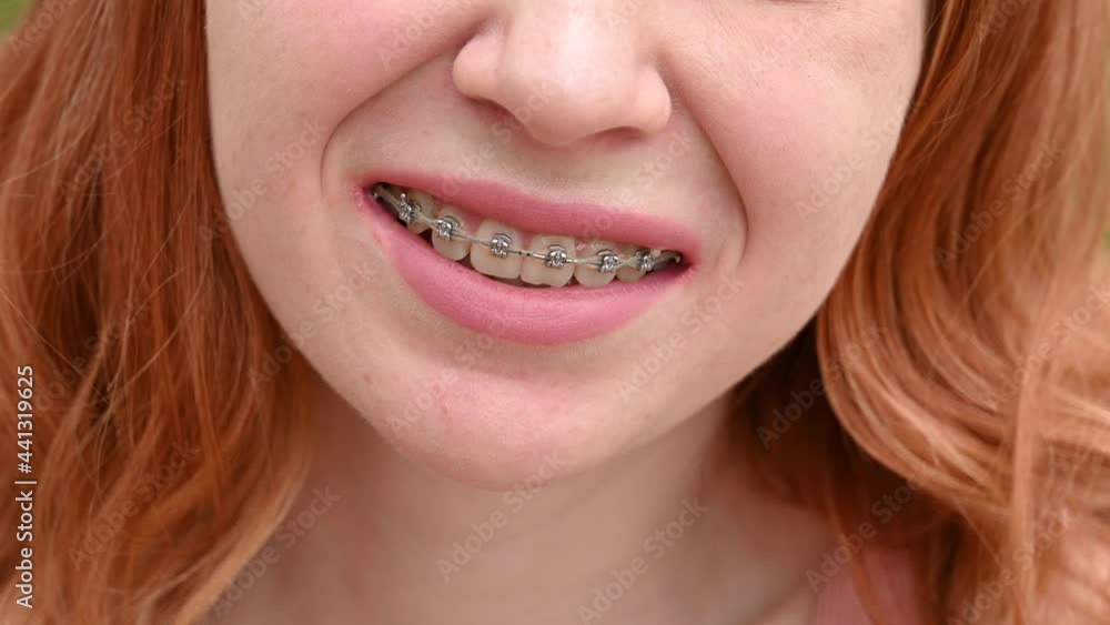 Beautiful young red-haired woman with braces on her teeth smiling in the summer outdoors Beautiful young red-haired woman with braces on her teeth smiling in the summer outdoors