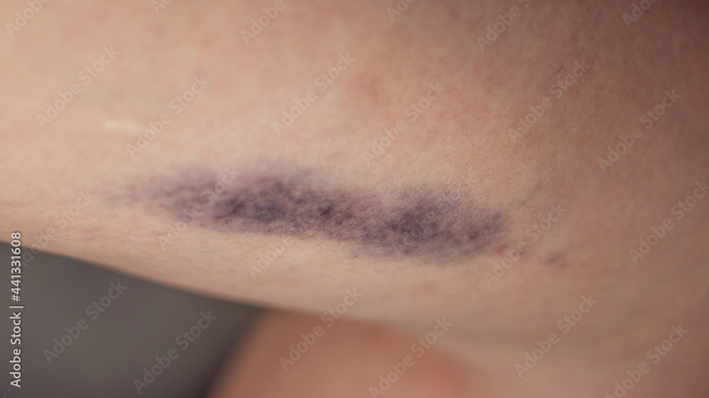 Fototapeta premium Big bruising on a woman's thigh.