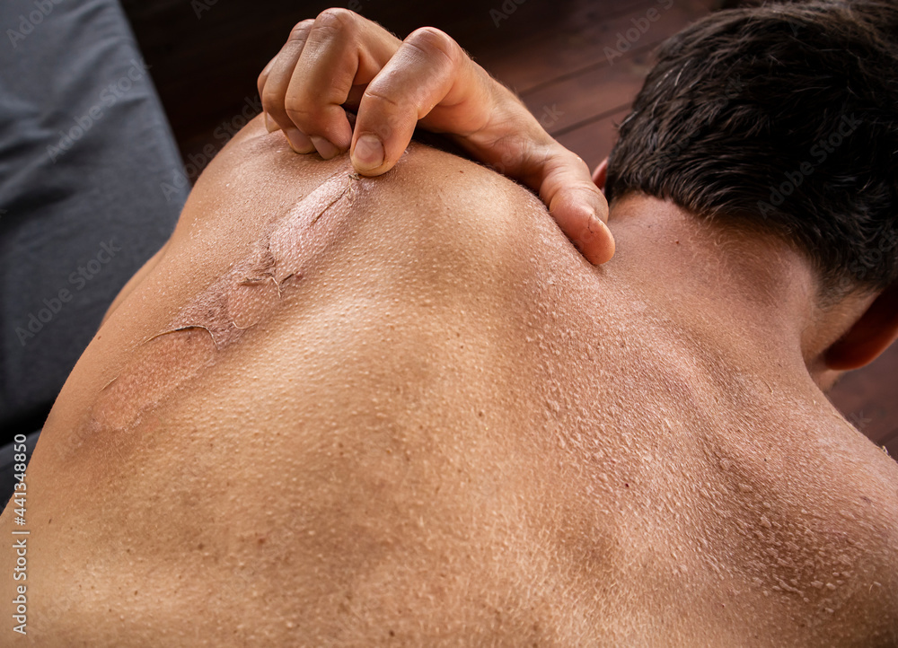 The dry and itching man's skin after sunbath The dry and itching man's skin after sunbath