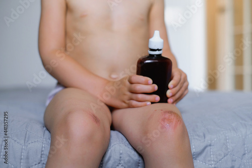 Children injury. Deep scratches on the skin on the kids knee. Wounds, scratches, abrasions on the child leg. Bottle of antiseptic and sponges to clean the wound 