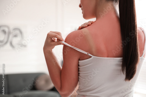 Woman with sunburned skin at home, closeup photo