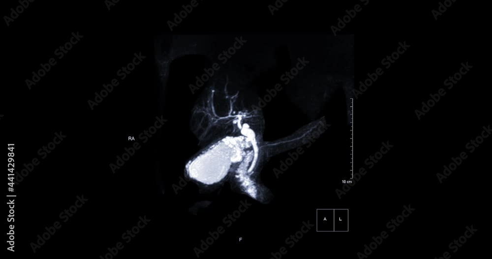 Mrcp View MRCP or Magnetic resonance cholangiopancreatography 3D MIP view showing ...