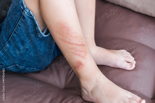Wounds, scratches and abrasions on skin of child leg. Children injury.