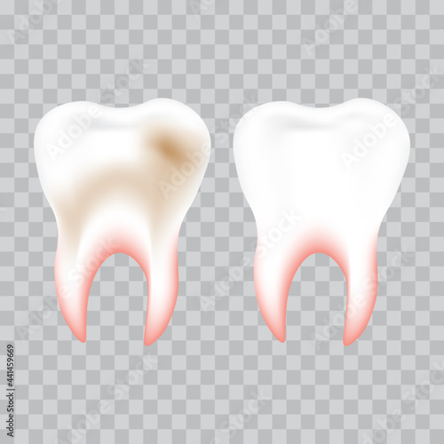 White tooth and with yellow plaque, teeth whitening and cleaning concept, vector illustration.