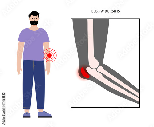 Student elbow bursitis