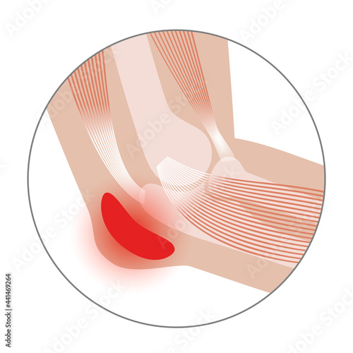 Student elbow bursitis