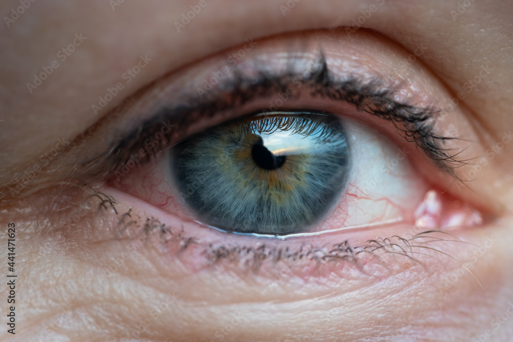 Obraz premium Close up of woman with irritated dry red eye or allergy. Female suffering from redness