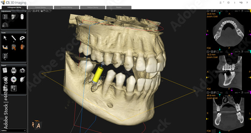 Dental CBCT image photo
