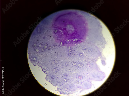 Photo of Squamous hyperplasia from oral mucosa sample, magnification 200x, photo under microscope photo