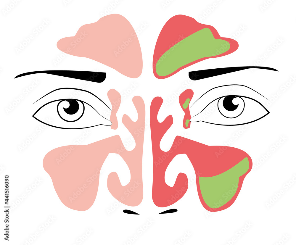 Sinusitis medical treatment. Nasal sinus. Healthy and inflammation