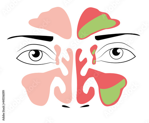 Sinusitis medical treatment. Nasal sinus. Healthy and inflammation sinus. Nasal diseases. Sinusitis, sinus infection diagnosis medical infographic design. Vector Eps.8
