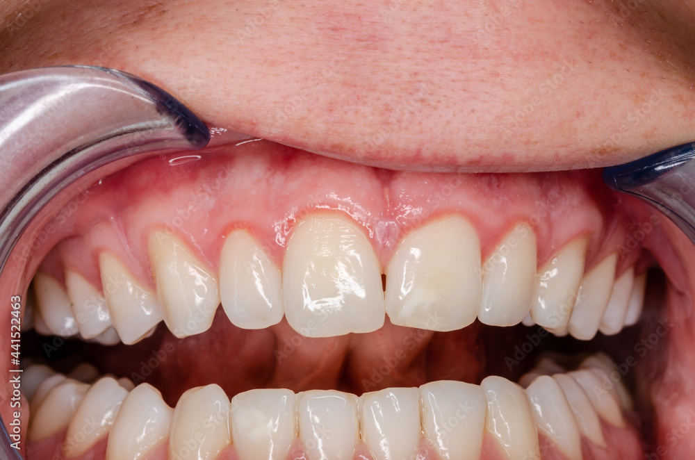 distinct gingivitis at frontal teeth, vessel growth at the gingival