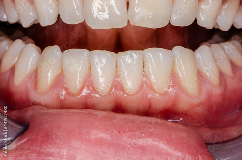 distinct gingivitis at frontal teeth, vessel growth at the gingival margin